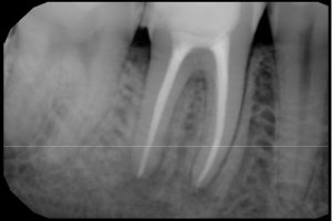 Leczenie kanałowe - ząb po zabiegu