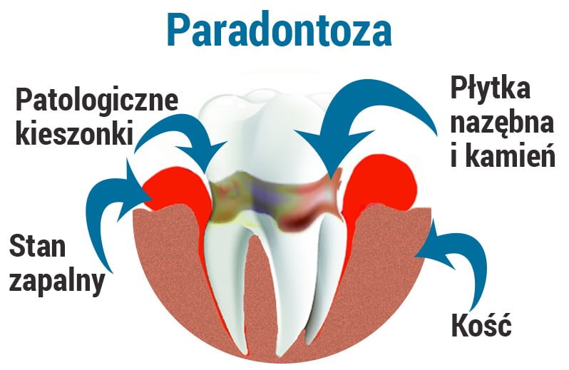paradontoza - schemat