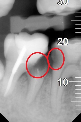 RTG próchnica zęba