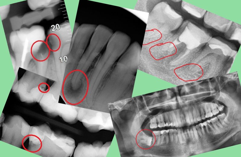 RTG zębów obrazy różnych schorzeń