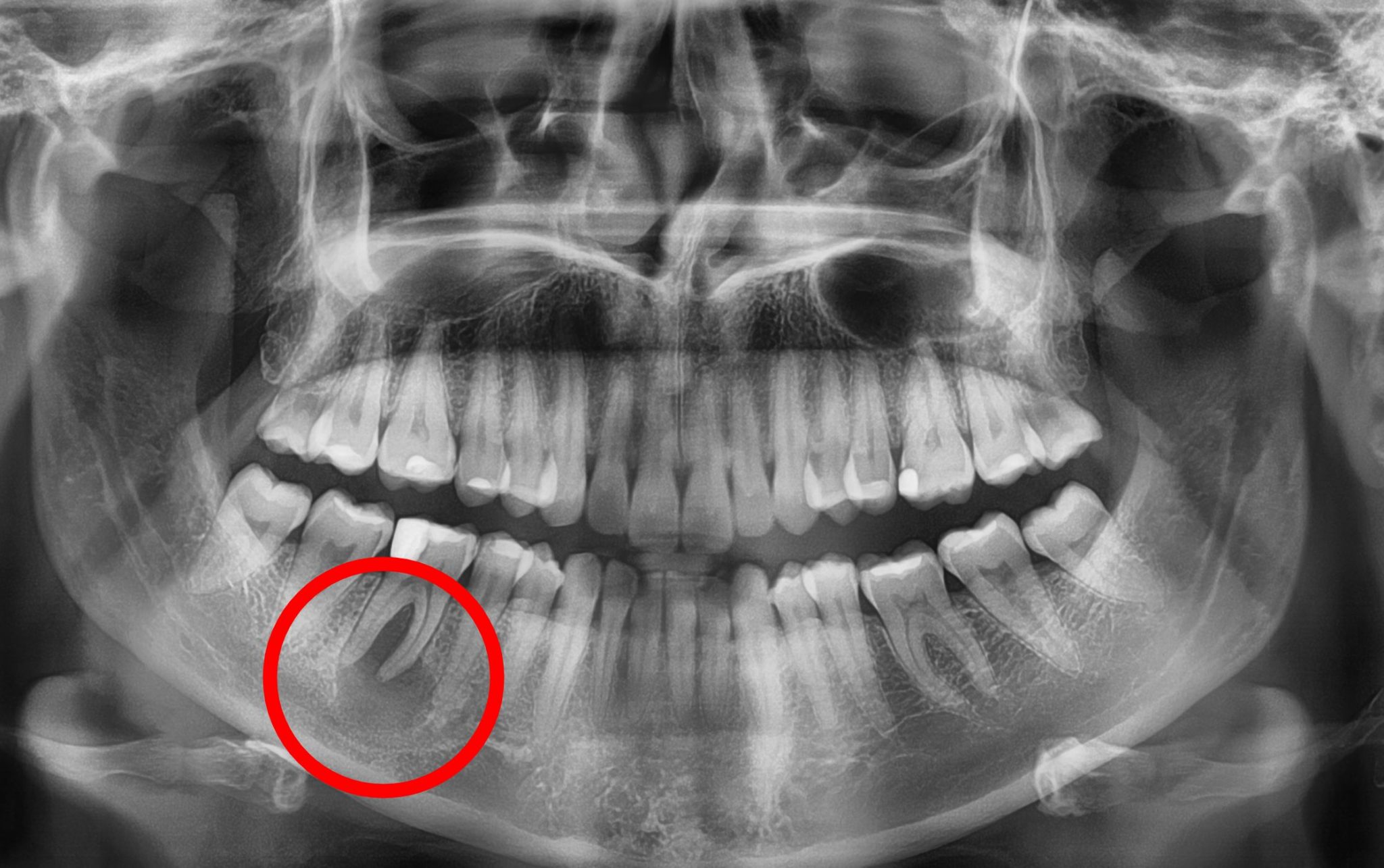 Torbiel Zastoinowa Na Wardze Sromowej Torbiele zębów przyczyny, objawy i leczenie - czy torbiele są groźne?