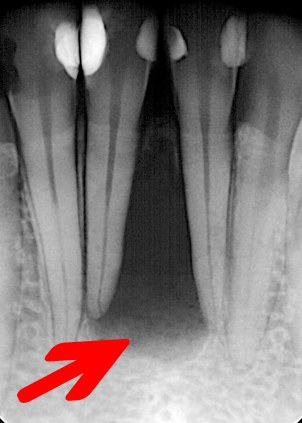 Torbiele zębów umiejscowienie między siekaczami po urazie