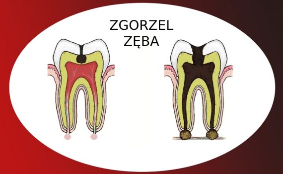 Zgorzel Zęba Martwica Miazgi Procesy Gnilne Objawy Leczenie U Dentysty 3568